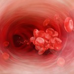 ¿Qué es la trombosis venosa profunda?
