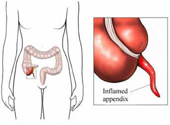 qué es la apendicitis