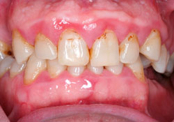 Tratamiento periodontitis