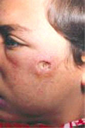 marcas leishmaniasis