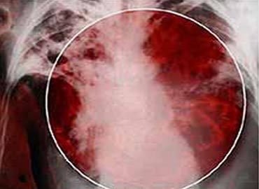 ¿Qué es la tuberculosis?